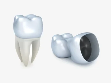 Is a Crown Always Needed After a Root Canal?